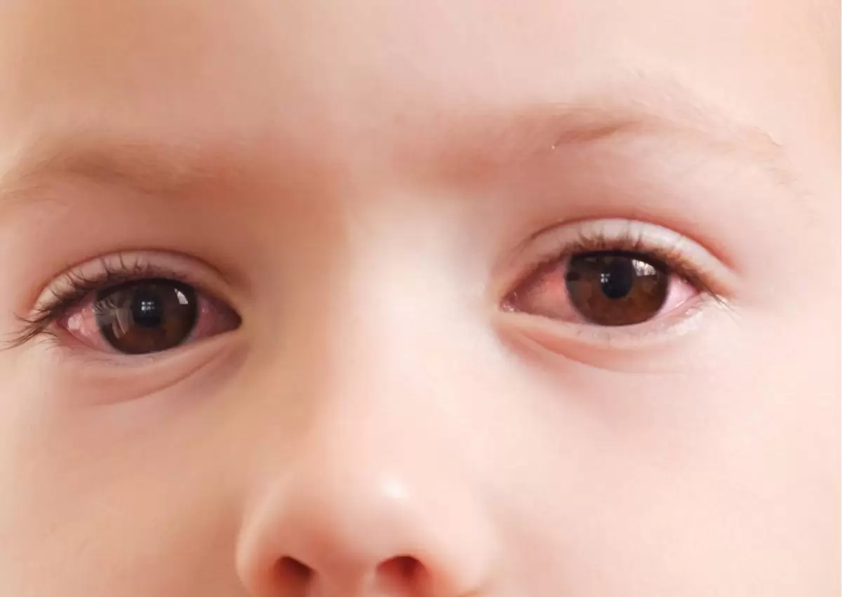 pink eye